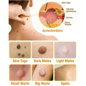 HOOMWELL™ Gentle Skin Tag & Wart Removal Spray with Tea Tree Oil