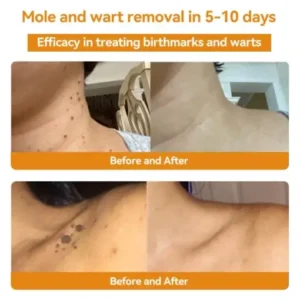 HOOMWELL™ Gentle Skin Tag & Wart Removal Spray with Tea Tree Oil