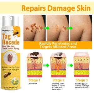 🔥 Save Up to 65% – HOOMWELL™ Gentle Skin Tag & Wart Removal Spray with Tea Tree Oil