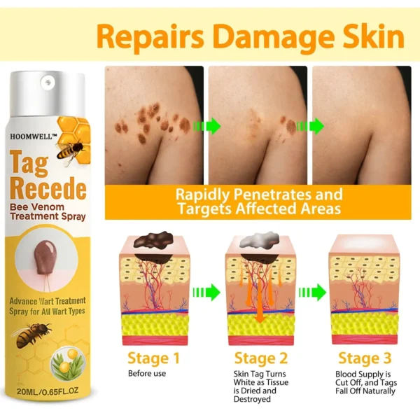 🔥 Save Up to 65% – HOOMWELL™ Gentle Skin Tag & Wart Removal Spray with Tea Tree Oil