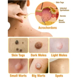 🔥 Save Up to 65% – HOOMWELL™ Gentle Skin Tag & Wart Removal Spray with Tea Tree Oil