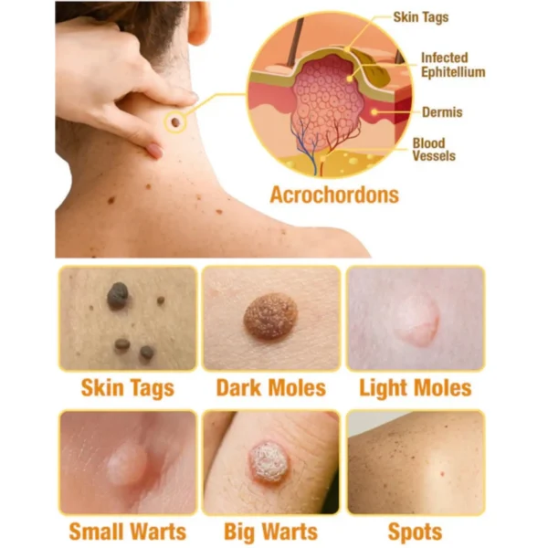 🔥 Save Up to 65% – HOOMWELL™ Gentle Skin Tag & Wart Removal Spray with Tea Tree Oil