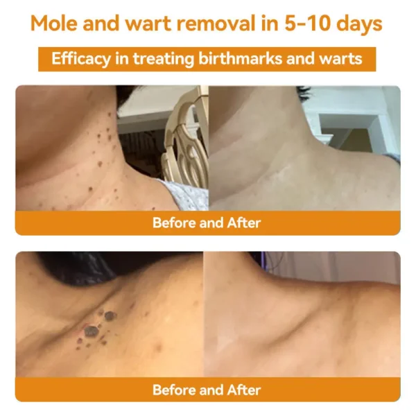 🔥 Save Up to 65% – HOOMWELL™ Gentle Skin Tag & Wart Removal Spray with Tea Tree Oil