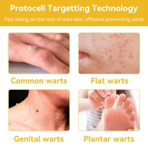 🔥 Save Up to 65% – HOOMWELL™ Gentle Skin Tag & Wart Removal Spray with Tea Tree Oil