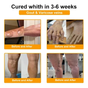 ⏰FLASH SALE: 59% OFF🔥HOOMWELL™ Botulinum Toxin & Bee Venom Pain-Relief Bone Healing Cream