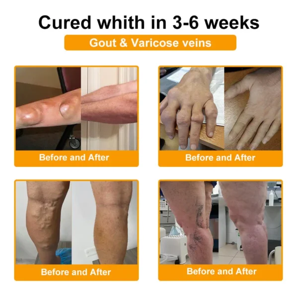 ⏰FLASH SALE: 59% OFF🔥HOOMWELL™ Botulinum Toxin & Bee Venom Pain-Relief Bone Healing Cream