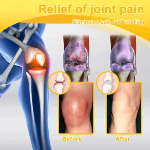 ⏰FLASH SALE: 59% OFF🔥HOOMWELL™ Botulinum Toxin & Bee Venom Pain-Relief Bone Healing Cream