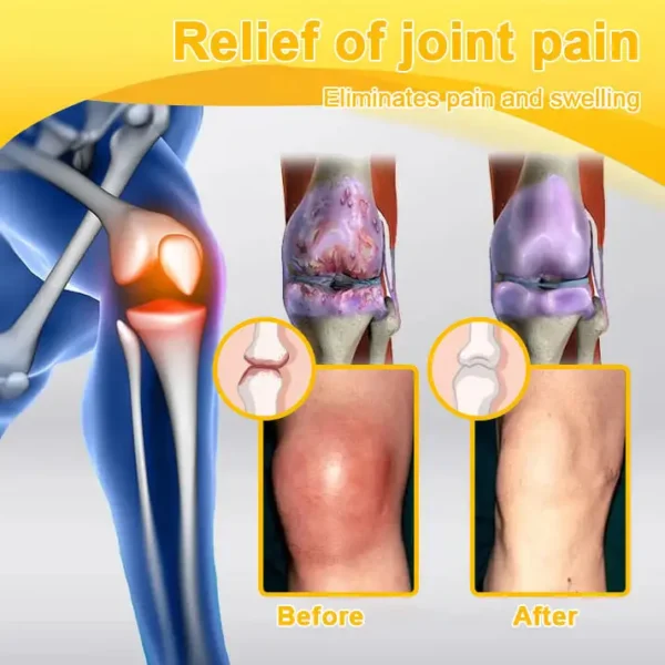 ⏰FLASH SALE: 59% OFF🔥HOOMWELL™ Botulinum Toxin & Bee Venom Pain-Relief Bone Healing Cream