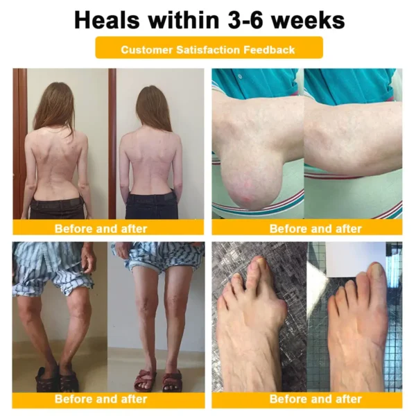 ⏰FLASH SALE: 59% OFF🔥HOOMWELL™ Botulinum Toxin & Bee Venom Pain-Relief Bone Healing Cream