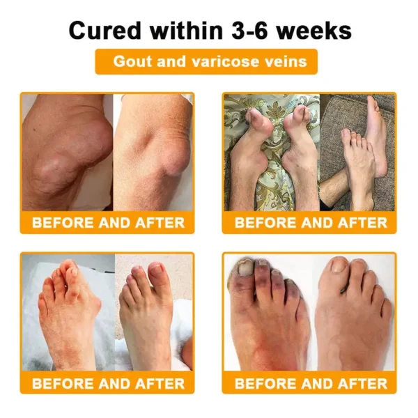 ⏰FLASH SALE: 59% OFF🔥HOOMWELL™ Botulinum Toxin & Bee Venom Pain-Relief Bone Healing Cream