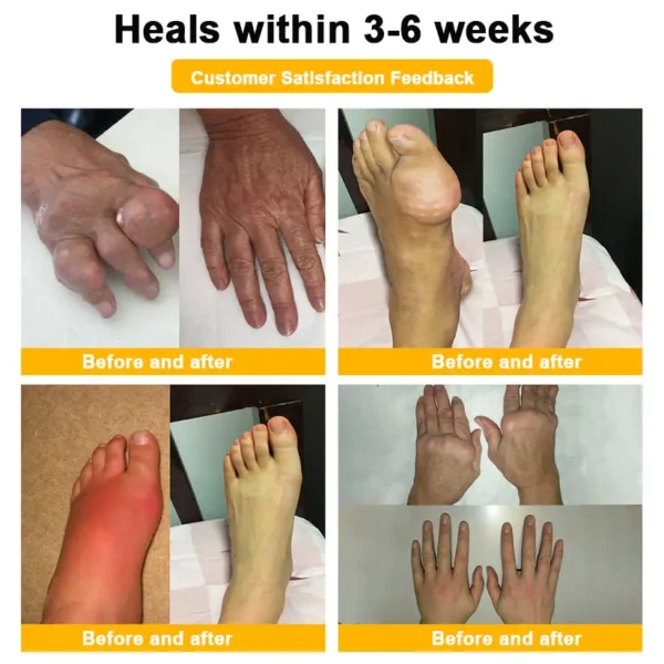 ⏰FLASH SALE: 59% OFF🔥HOOMWELL™ Botulinum Toxin & Bee Venom Pain-Relief Bone Healing Cream